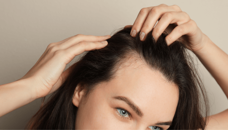 alopecia androgenética feminina